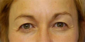 Eyelid (Blepharoplasty)