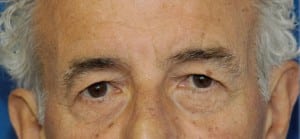Eyelid (Blepharoplasty)