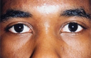 Eyelid (Blepharoplasty)