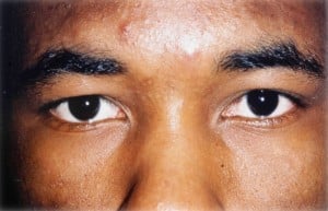 Eyelid (Blepharoplasty)