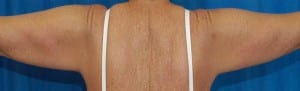 Brachioplasty