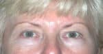 Eyelid (Blepharoplasty)