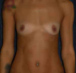 Breast Augmentation