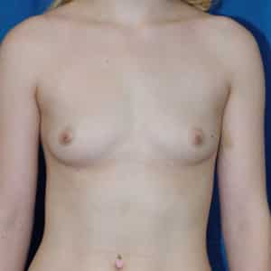 Breast Augmentation