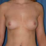 Breast Augmentation
