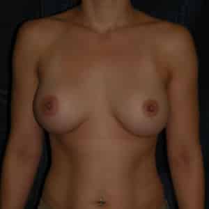 Breast Augmentation