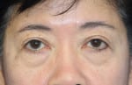 Eyelid (Blepharoplasty)