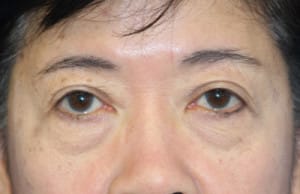 Eyelid (Blepharoplasty)