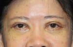 Eyelid (Blepharoplasty)