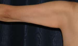 Brachioplasty