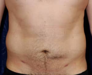 Liposuction