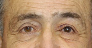 Eyelid (Blepharoplasty)