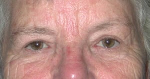 Eyelid (Blepharoplasty)