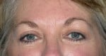 Eyelid (Blepharoplasty)