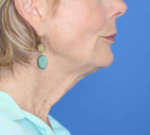Natural Neck Lift