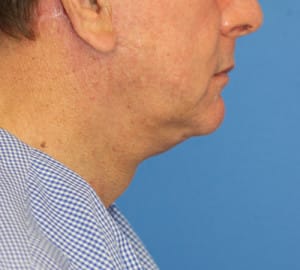 Natural Neck Lift