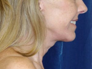 Natural Neck Lift