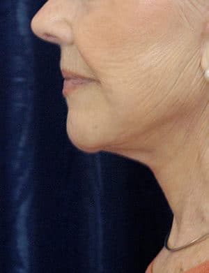 Natural Neck Lift