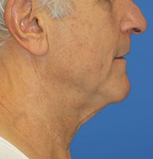 Natural Neck Lift