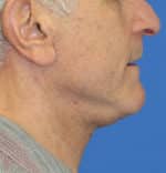 Natural Neck Lift