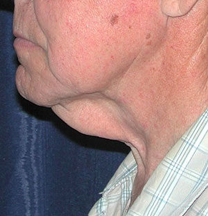 Natural Neck Lift