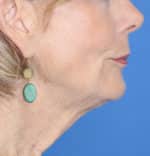 Natural Neck Lift