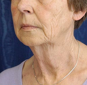 Natural Neck Lift