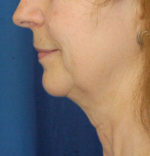 Natural Neck Lift