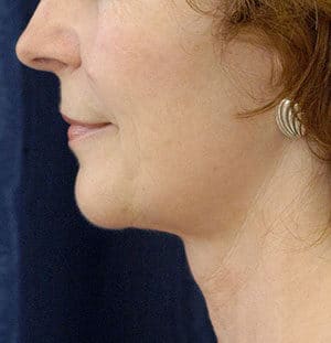 Natural Neck Lift