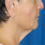 Natural Neck Lift