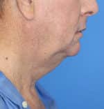 Natural Neck Lift