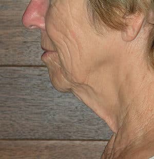 Natural Neck Lift