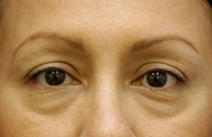 Eyelid (Blepharoplasty)