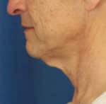 Natural Neck Lift