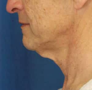 Natural Neck Lift