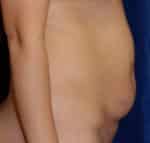 Abdominoplasty