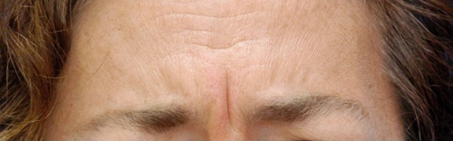 Botox Before and After Results