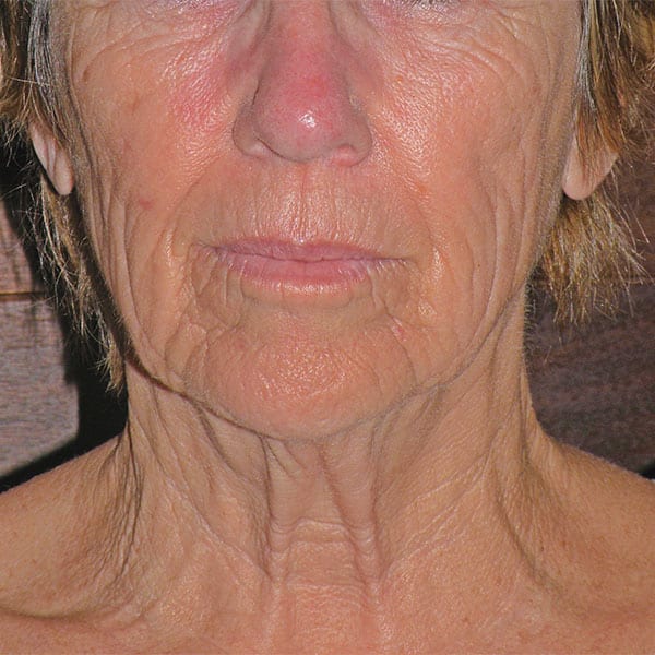 Volumetric Restoration Before Photos