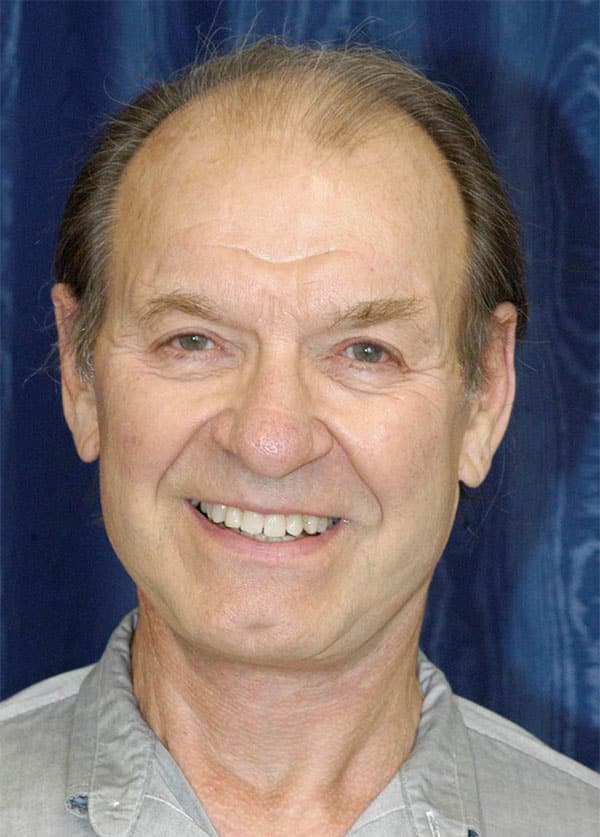 Natural Neck Lift for Men After Photos