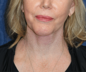 Natural Neck Lift