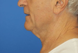 Natural Neck Lift