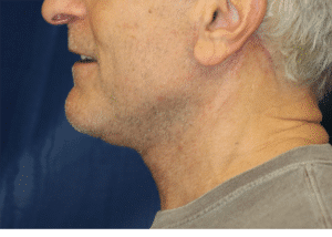 Natural Neck Lift