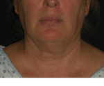 Natural Neck Lift