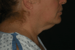 Natural Neck Lift