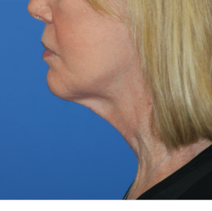 Natural Neck Lift