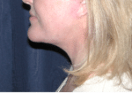 Natural Neck Lift