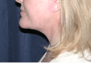 Natural Neck Lift
