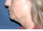 Natural Neck Lift