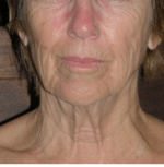 Natural Neck Lift