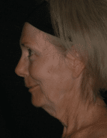 Natural Neck Lift